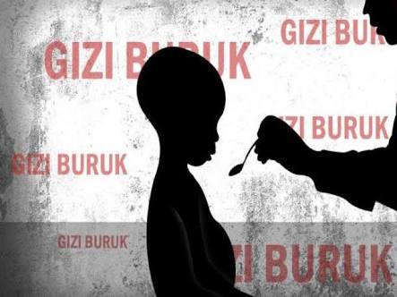Di Bojonegoro, Penderita Gizi Buruk Menurun